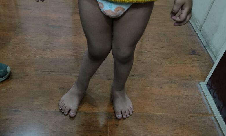 डॉ. नौटियाल बोले, समय से पहले बच्चों को न दे वॉकार, बदल सकता है हड्डी का शेप